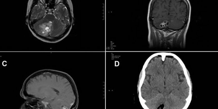 Surgery Reveals That Supposed Brain Tumor is a Parasite