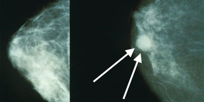 False-Positive Mammograms Indicate Increased Breast Cancer Risk