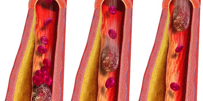 Ultrasound "Drill" Dissolves Deep Blood Clots with Impeccable Precision