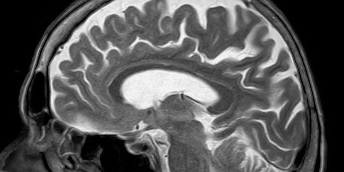 Brain Scan White Spots Can Indicate Dementia