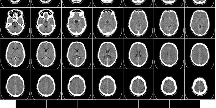 Influenza Vaccine Shown to Decrease the Risk of Alzheimer's Disease