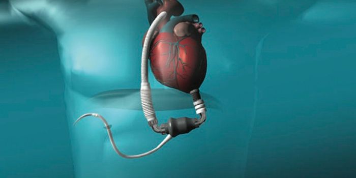 Pump Thrombosis - Is It On the Rise or Not?