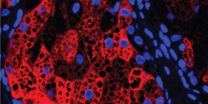 Skin Condition Linked to Sex Hormone Gene