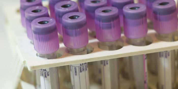 Algorithm-Based Blood Test Diagnoses Autism