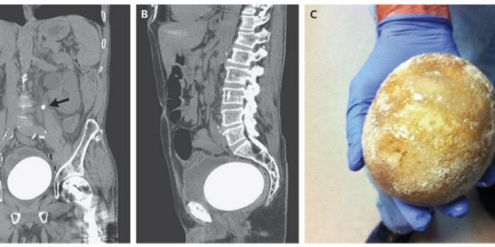 Man's Bladder Stone was Nearly the Size of an Ostrich Egg