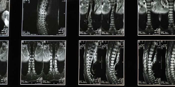 Stem Cell Grafting Shows Promise for Spinal Cord Injury
