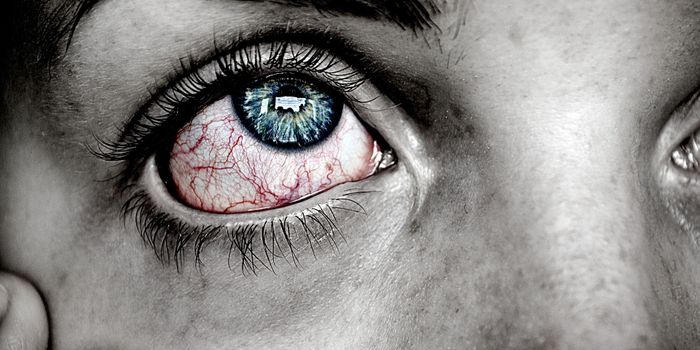 Itchy, red, dry eyes? FDA approves monthly implant for allergic conjunctivitis