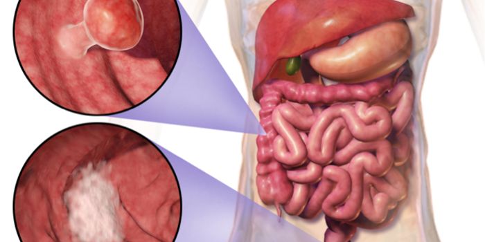 Bowel Cancer Rates Tied to Economic Prosperity