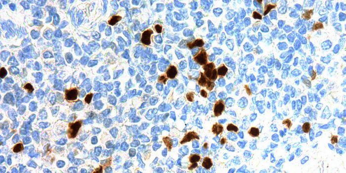 TdT Positive Cells - Not Just for Neoplasms