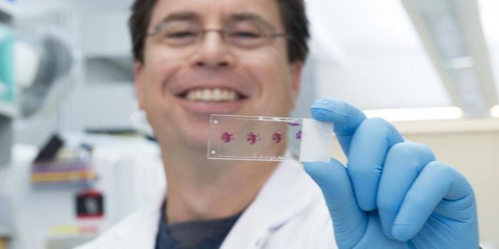 Genetic Mutation Linked to Increased Pancreatic Cancer Risk in Women