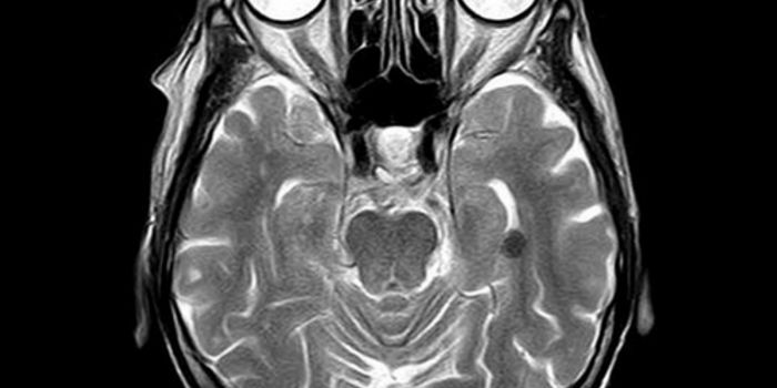 Repairing the Brain After a Stroke