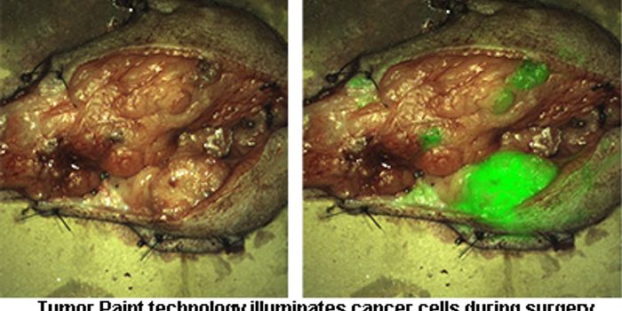 ‘Paint' Technique Blows Tumor's Camouflage In The Brain