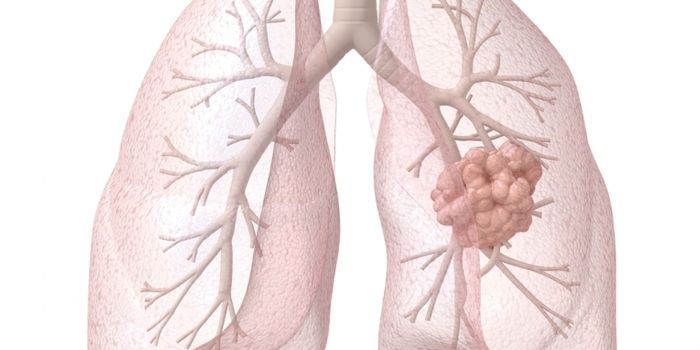 Immunotherapy Better for Non-Small-Cell Lung Cancer Patients
