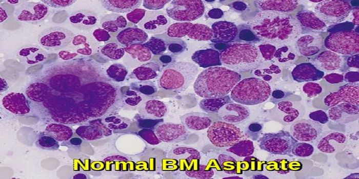 Rare Bone Marrow Manifestation in Sarcoidosis