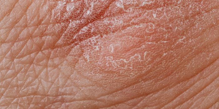 The Genetics of Skin Inflammation, Seen With Unprecedented Clarity