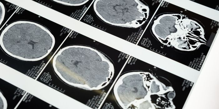Experimental Anti-amyloid Treatment Fails to Slow Cognitive Decline