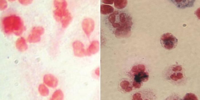 A Rare Genetic Disorder is Effectively Treated With Modified Stem Cells