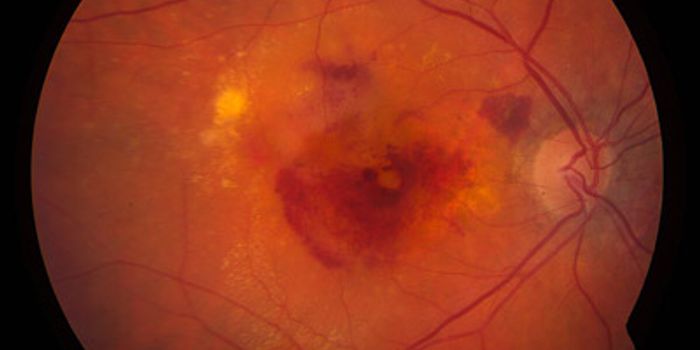 Inhibiting Mast Cell Degranulation: A New Therapy For Macular Degeneration