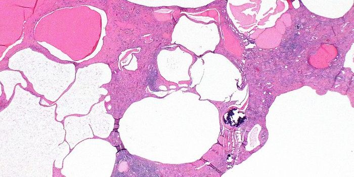 How a Heart Attack Affects the Kidneys