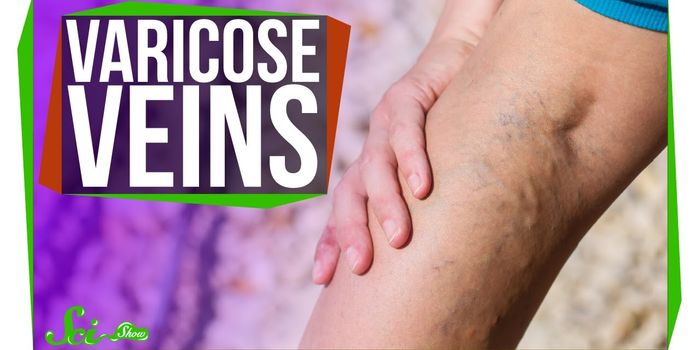 Who Gets Varicose Veins?