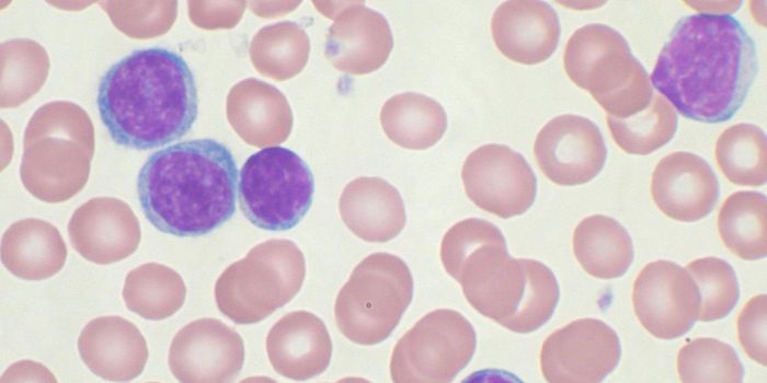 'Melting Away' Chronic Lymphocytic Leukemia (CLL)