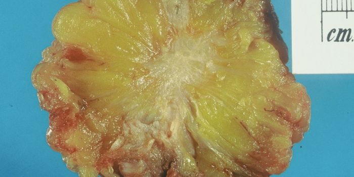 Differences in the Bacterial Makeup of Cancerous & Healthy Breast Tissue