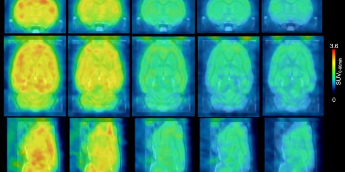 Advanced PET Imaging for Brain Disease Detection