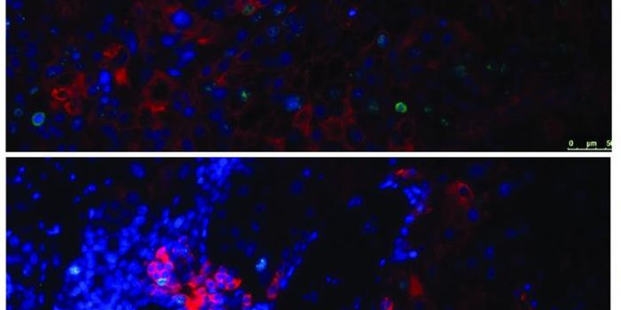 Molecular Link Between Sarcoma & Prostate Cancer Could aid Therapeutics