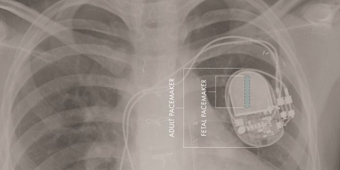 Tiny Pacemaker for Fetus