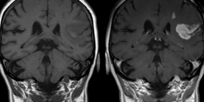 Brain Stimulation for Stroke Treatment?