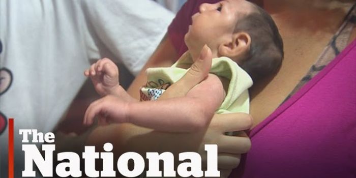 CDC Confirms Zika Causes Microcephaly
