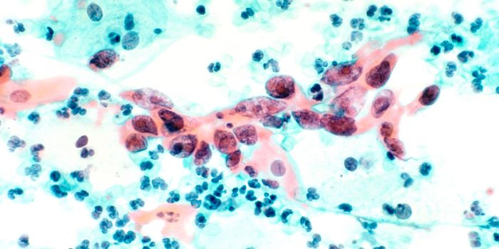 Stopping the Spread of Cancer