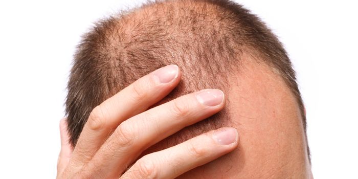 No More Hair Loss? Osteoporosis Drug Treats Baldness