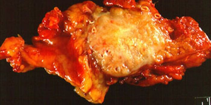 Study IDs MicroRNA as a New Target for Pancreatic Cancer