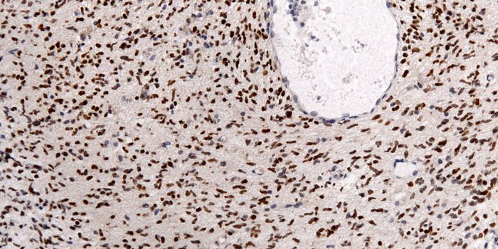 Algorithm Predicts Glioma Survival Better Than Specialists