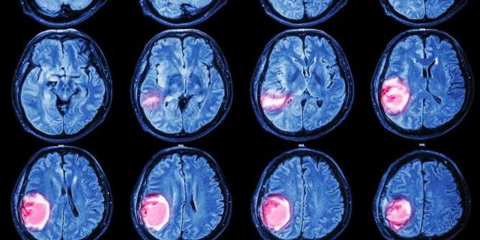 Aggressive Brain Tumor Has a Telltale Genetic Mutation