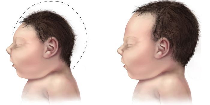 Microcephaly can be Caused by Nondividing Stem Cells