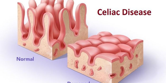 Gut Microbiota Impact Who Develops Celiac Disease