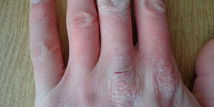 Experts Provide Update on New Drugs for Eczema