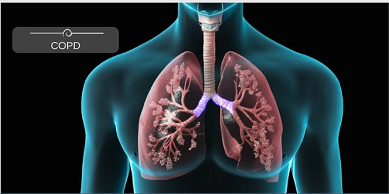 Chronic Obstructive Pulmonary Disease Copd Webinars